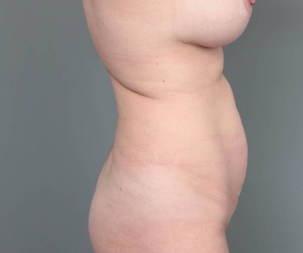 before tummy tuck female patient right side view case 4404
