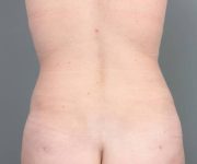 after tummy tuck female patient back view case 4404