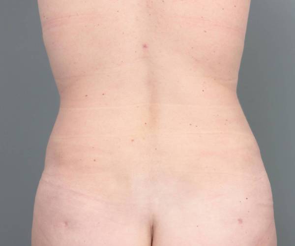 after tummy tuck female patient back view case 4404