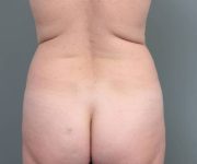 before tummy tuck female patient back view case 4404