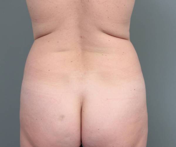 before tummy tuck female patient back view case 4404