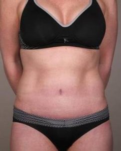after tummy tuck female patient front view case 4421