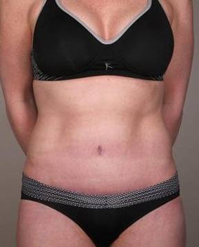 after tummy tuck female patient front view case 4421