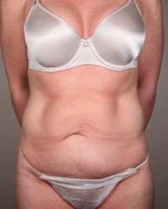 before tummy tuck female patient front view case 4421