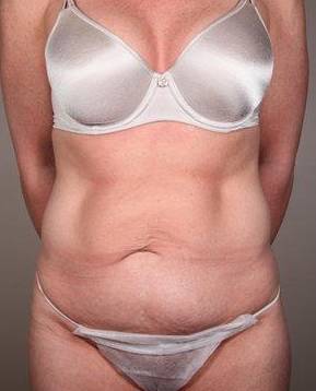 before tummy tuck female patient front view case 4421