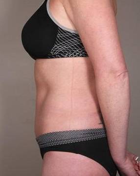 after tummy tuck female patient left side view case 4421