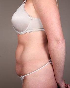 before tummy tuck female patient left side view case 4421