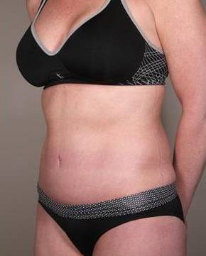 after tummy tuck female patient left angle view case 4421
