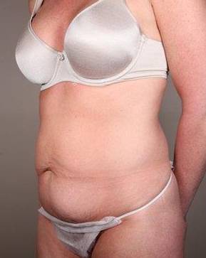 before tummy tuck female patient left angle view case 4421