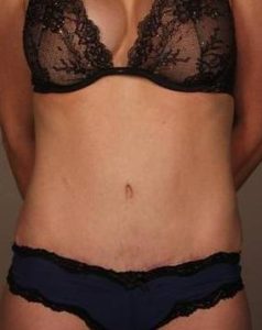 after tummy tuck female patient front view case 4428
