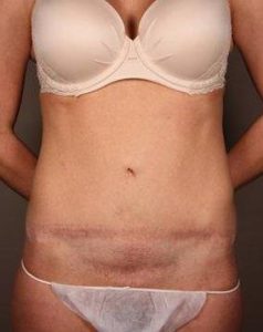 before tummy tuck female patient front view case 4428