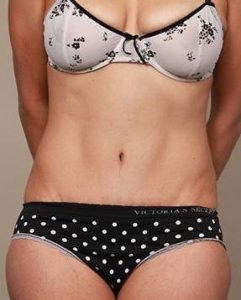 after tummy tuck female patient front view case 4431
