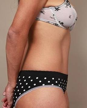 after tummy tuck female patient right side view case 4431