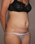 before tummy tuck female patient right angle view case 4431