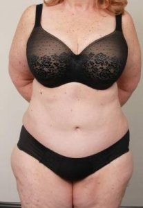 after tummy tuck female patient front view case 4438