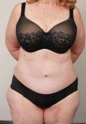 after tummy tuck female patient front view case 4438