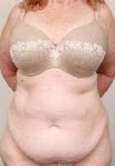 before tummy tuck female patient front view case 4438