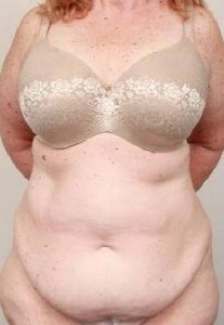 before tummy tuck female patient front view case 4438