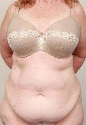 before tummy tuck female patient front view case 4438