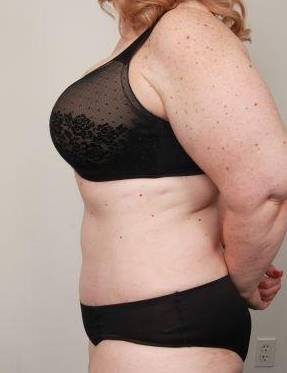after tummy tuck female patient left side view case 4438