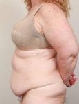 before tummy tuck female patient left side view case 4438