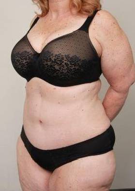 after tummy tuck female patient left angle view case 4438