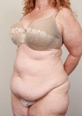 before tummy tuck female patient left angle view case 4438