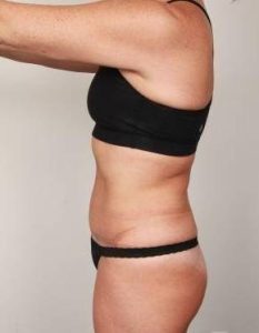 after tummy tuck female patient left side view case 4451