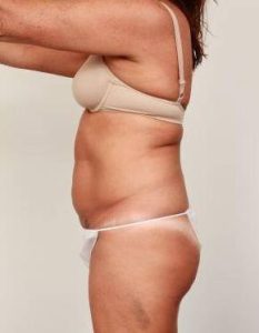 before tummy tuck female patient left side view case 4451