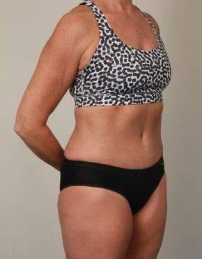 after tummy tuck female patient right angle view case 4451