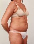 before tummy tuck female patient right angle view case 4451