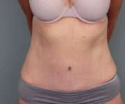 after tummy tuck female patient front view case 4456