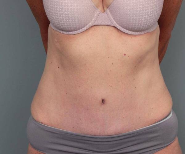 after tummy tuck female patient front view case 4456
