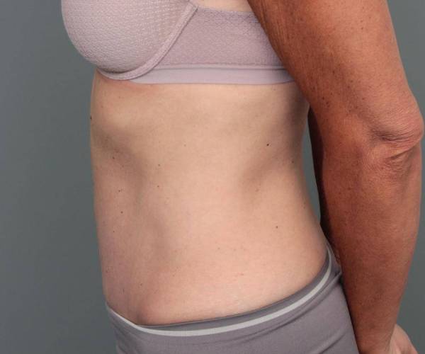 after tummy tuck female patient left side view case 4456