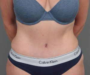 after tummy tuck female patient front view case 4468