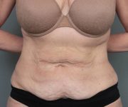 before tummy tuck female patient front view case 4468