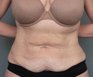 before tummy tuck female patient front view case 4468