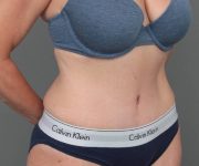 after tummy tuck female patient right angle view case 4468