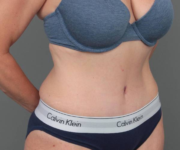 after tummy tuck female patient right angle view case 4468