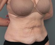 before tummy tuck female patient right angle view case 4468