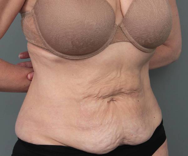 before tummy tuck female patient right angle view case 4468