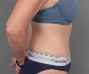 after tummy tuck female patient right side view case 4468
