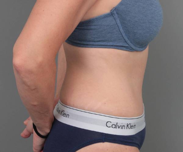 after tummy tuck female patient right side view case 4468