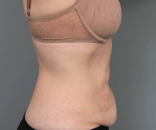 before tummy tuck female patient right side view case 4468