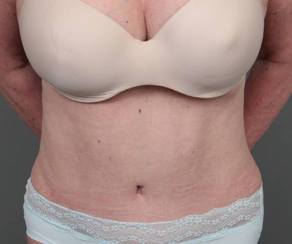 after tummy tuck female patient front view case 4475
