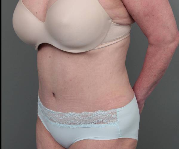 after tummy tuck female patient left angle view case 4475