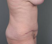 after tummy tuck female patient right side view case 4475