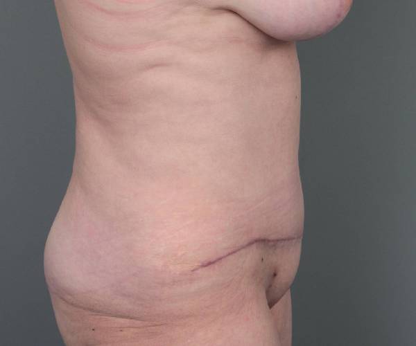 after tummy tuck female patient right side view case 4475