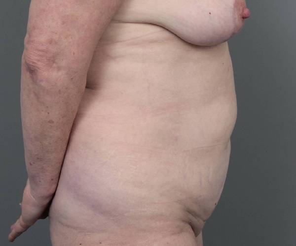 before tummy tuck female patient right side view case 4475