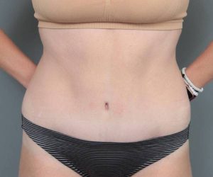 after tummy tuck female patient front view case 4482